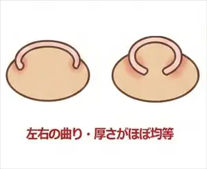 巻き爪ロボAタイプ