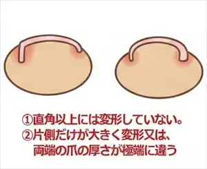 巻き爪ロボBタイプ